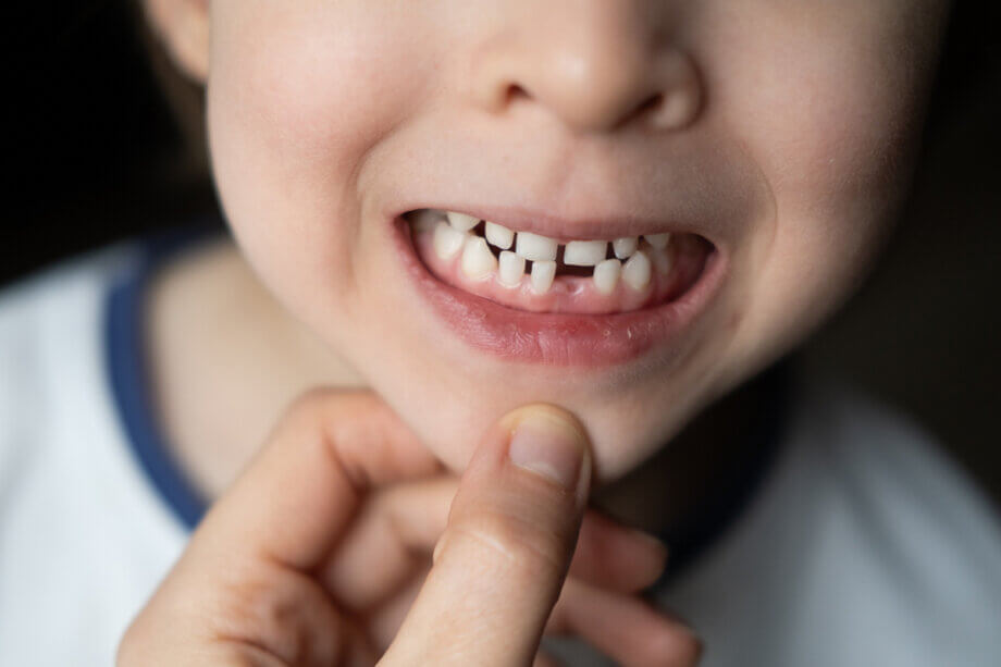 Does Your Child Need a Space Maintainer After Losing a Tooth?