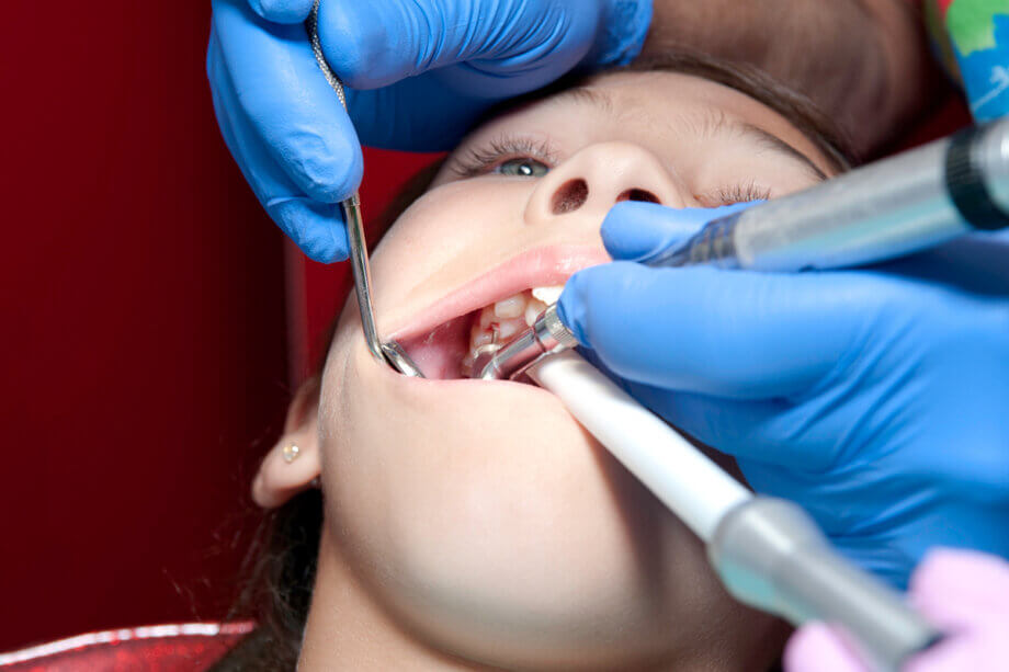 What Is a Pulpotomy and When Is It Needed?